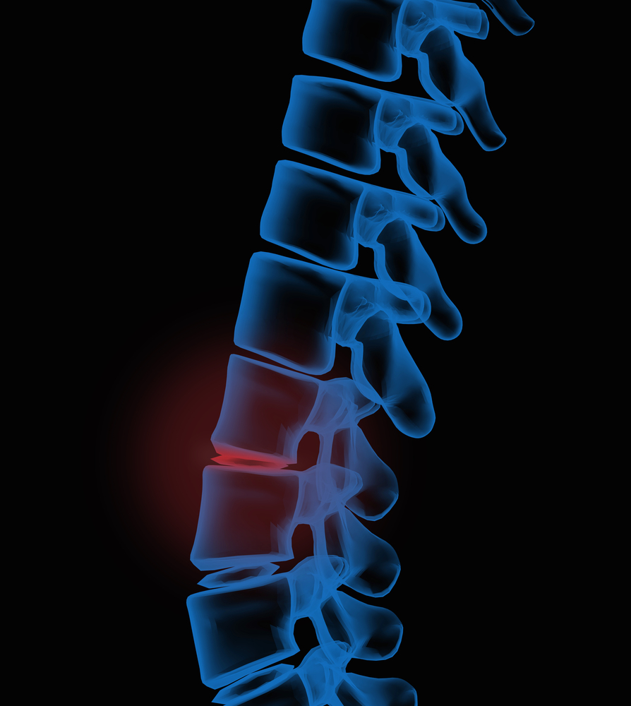 Back-Pain-After-Car-Accident-Puyallup-WA