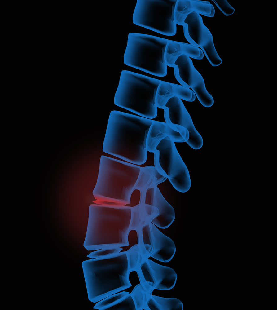 Lower-Back-Pain-Spanaway-WA